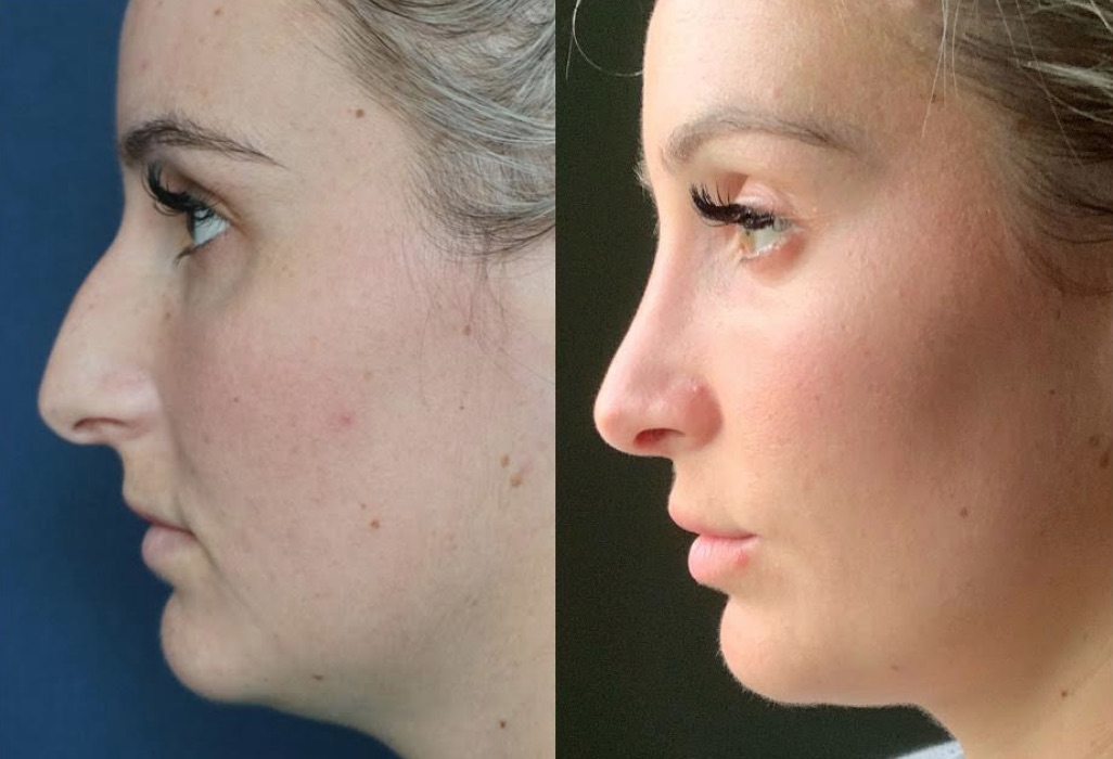 Before & After Rhinoplasty 82 CosMediTour