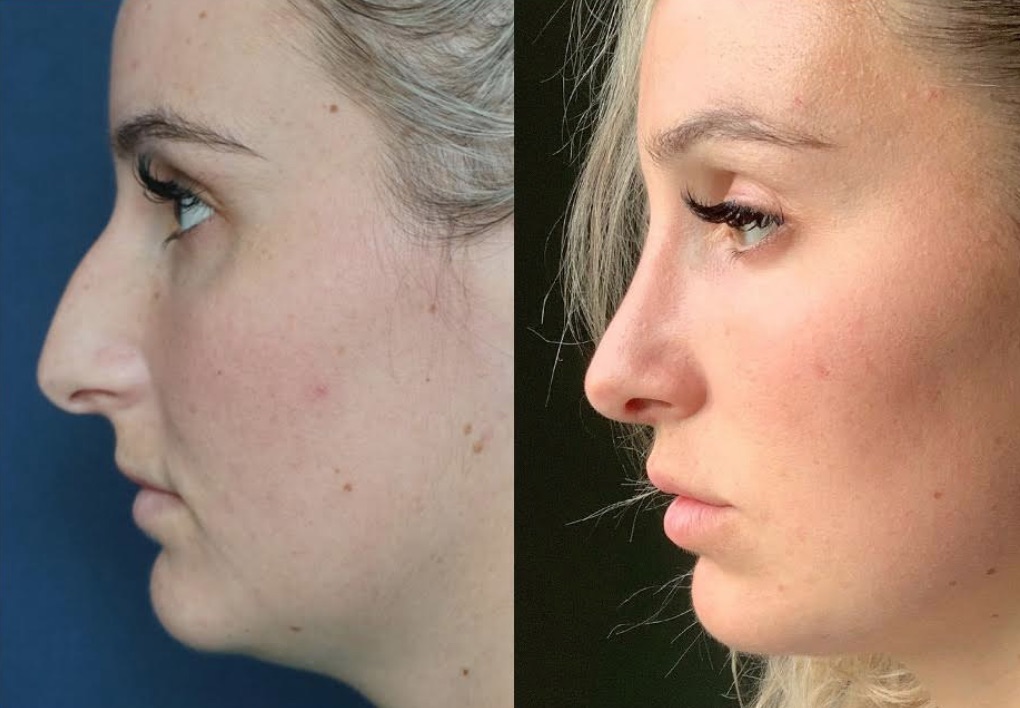 Before & After Rhinoplasty #82