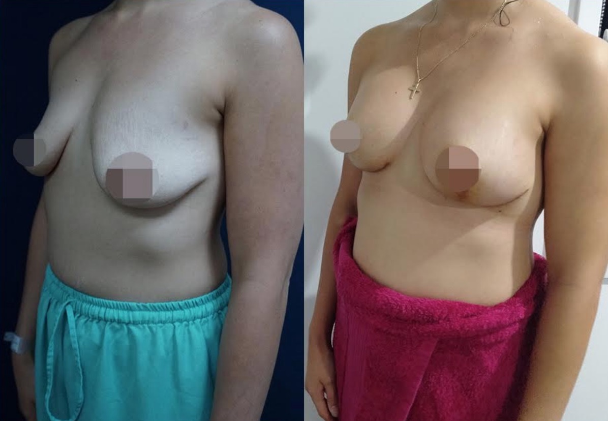 Breast Lift & Augmentation Result #150