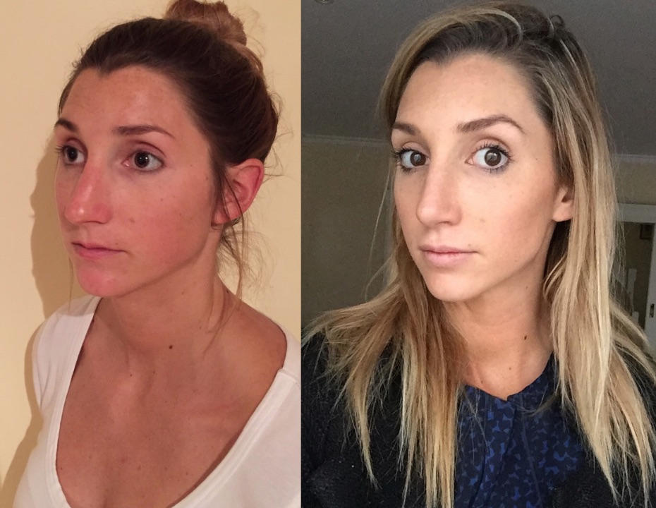 Tip Reduction Rhinoplasty (Nose Correction) Surgery Results by Dr Montien