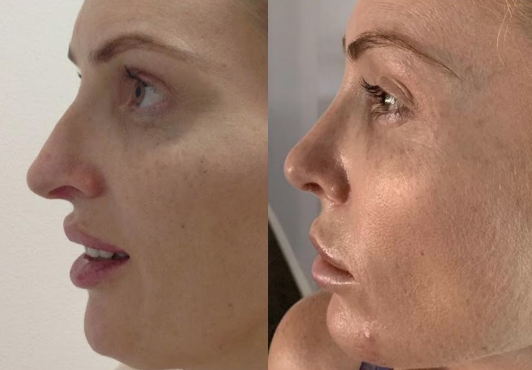 Corrine’s Rhinoplasty Results in Bangkok by CosMediTour’s Dr Supasid