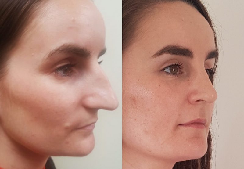 Sarah's Incredible Rhinoplasty Results by CosMediTour's Dr Supasid