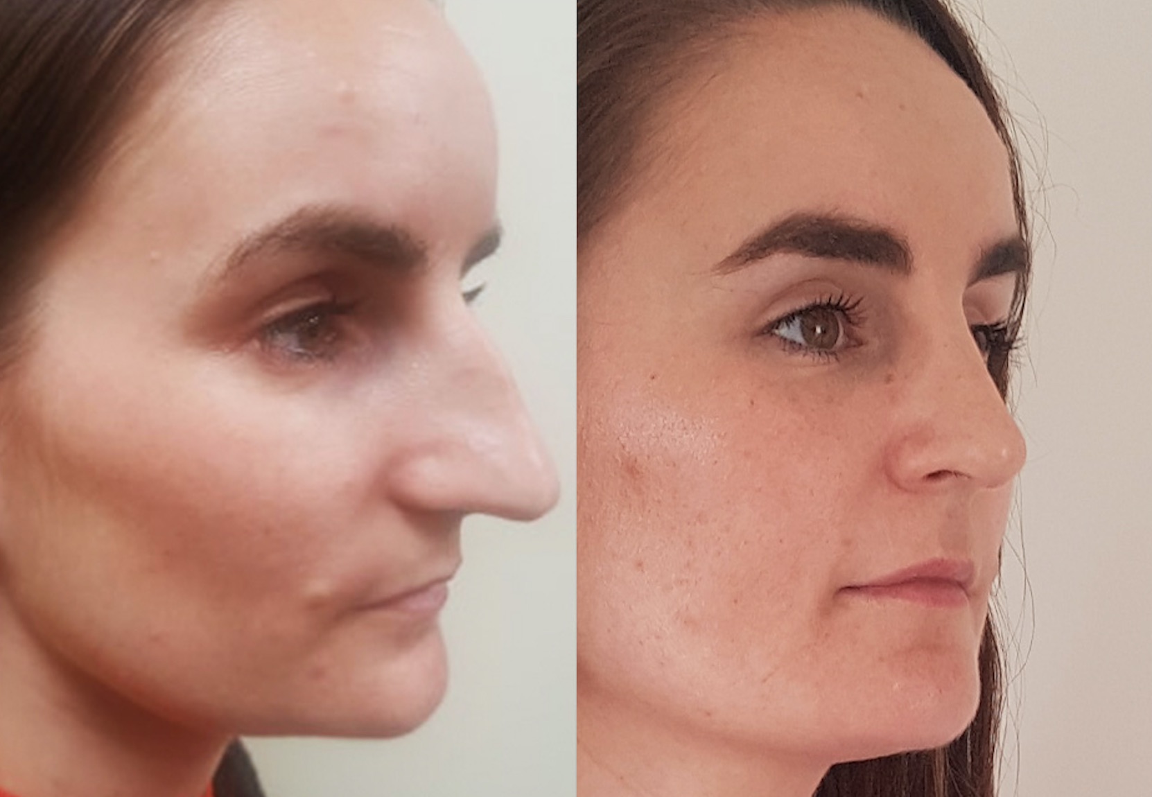 Before & After Rhinoplasty #85