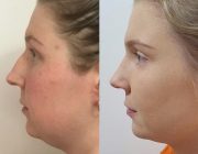 CosMediTour Rhinoplasty (Nose Correction) Results by Dr Montien