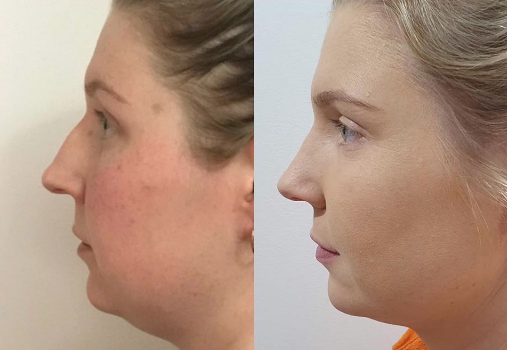 Before & After Rhinoplasty #84