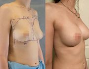 Koh Samui Breast Augmentation Results by CosMediTour's Dr Sanguan
