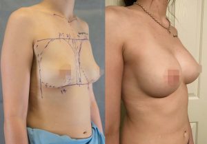 Koh Samui Breast Augmentation Results by CosMediTour's Dr Sanguan