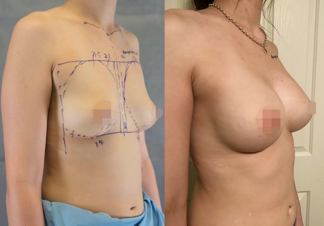 Breast Augmentation Before & After #331