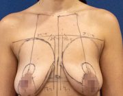 Felicity's Life Changing Breast Lift + Augmentation Surgery Video