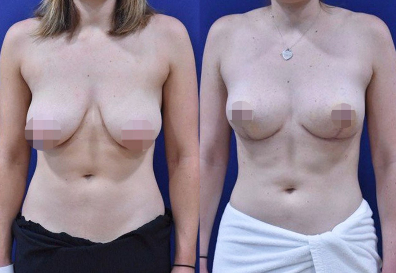 Breast Reduction Before & After #15