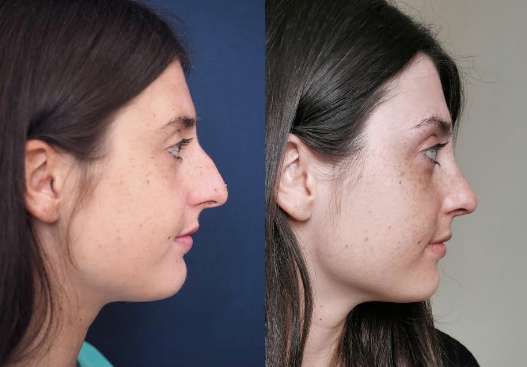 Before & After Rhinoplasty #86