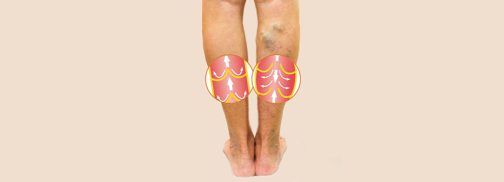 What is Deep Vein Thrombosis?