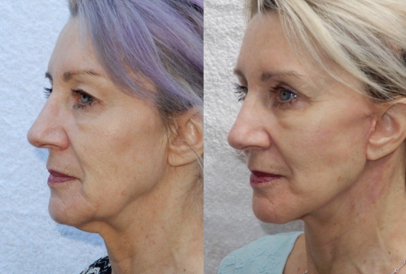 Facelift and Eyelid Lift Before and After #36