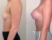 best breast augmentation