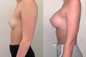 best breast augmentation