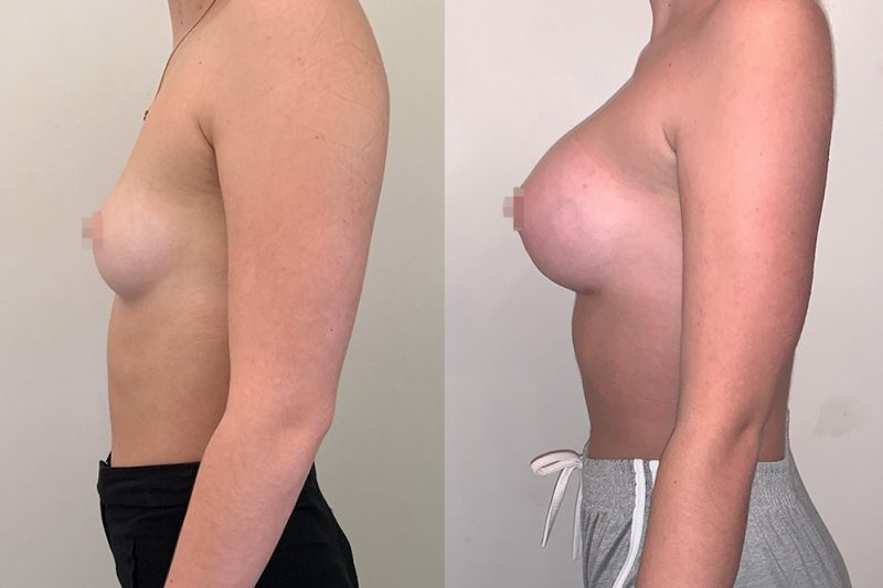 best breast augmentation