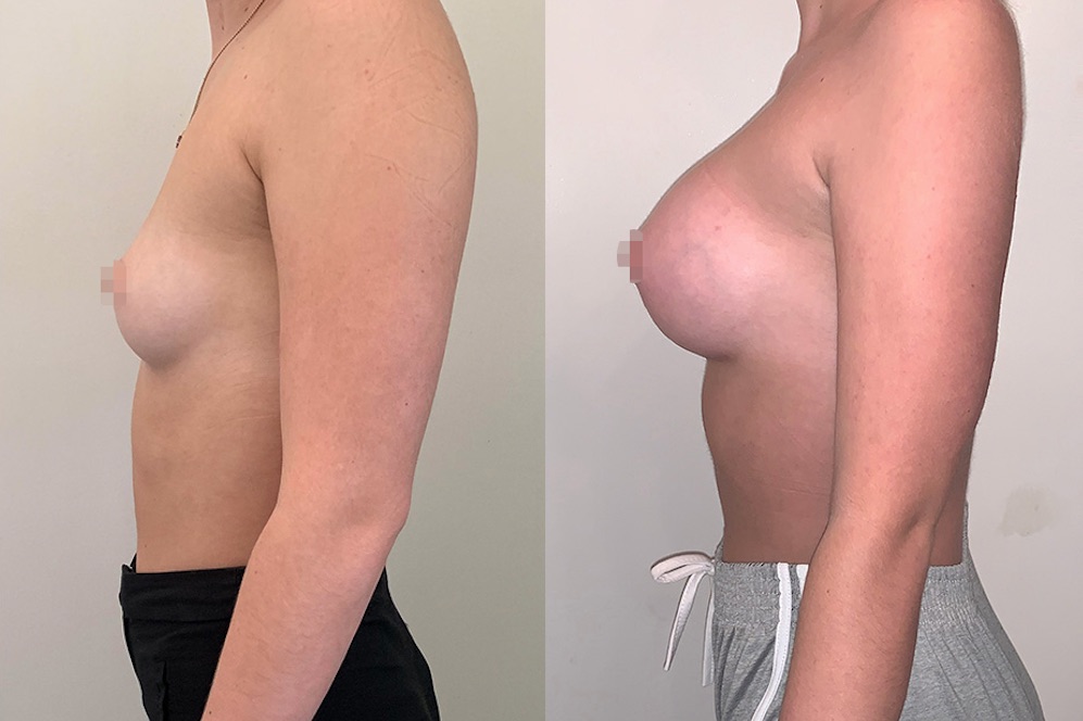 Breast Augmentation Before & After #339