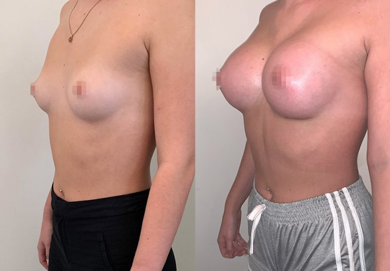 best breast surgery thailand