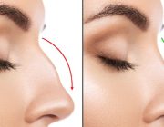 arrows indicate height of nasal dorsum pre and post preservation rhinoplasty