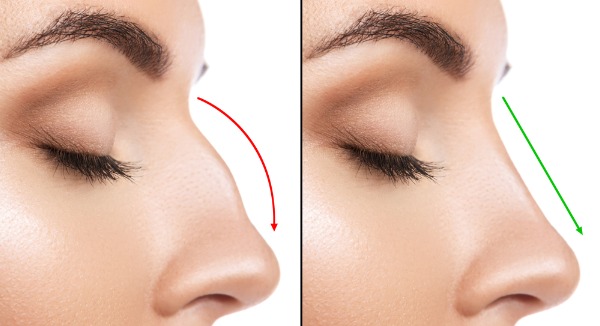 arrows indicate height of nasal dorsum pre and post preservation rhinoplasty