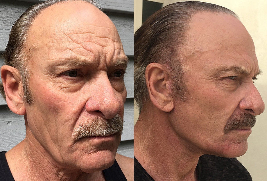 Facelift Before and After #37