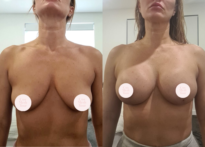 Breast Lift & Augmentation Result #157