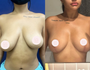 Breast Lift Result 01