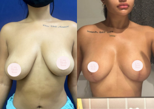 Breast Lift Result 01