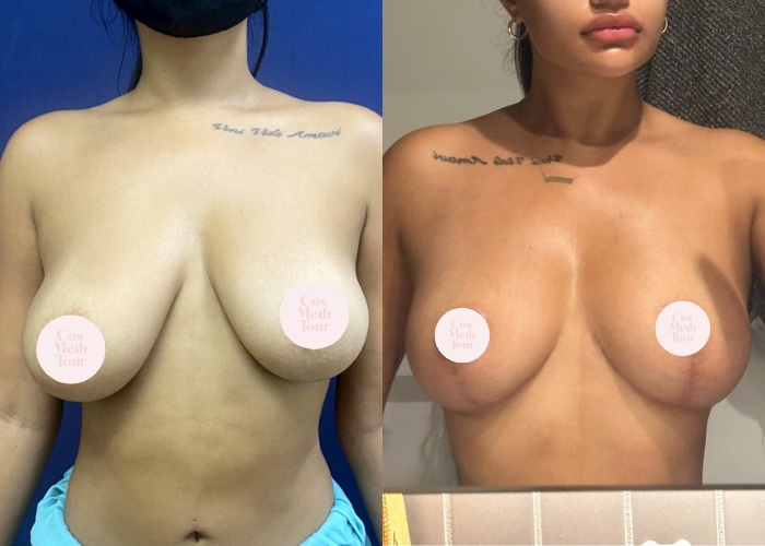 Breast Lift Before & After #8