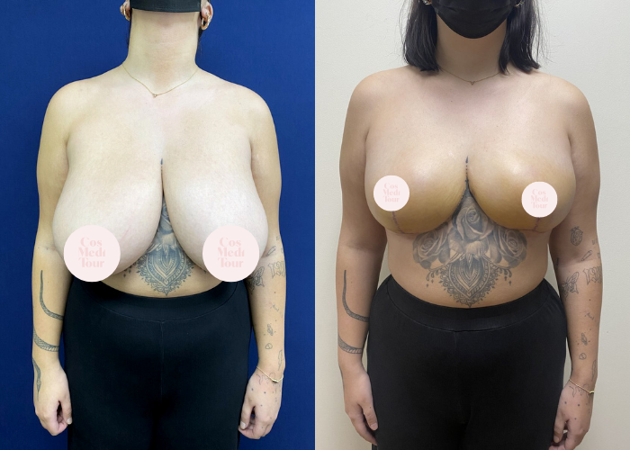Breast Reduction Before & After #16
