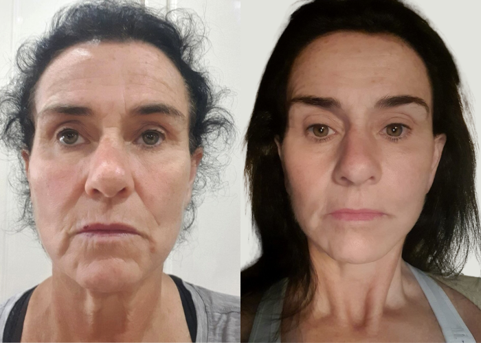 Facelift Before and After #39