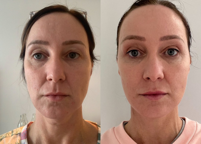 Fresh Female Facelift