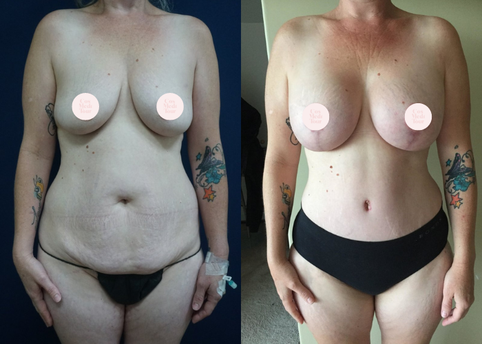 Mummy Makeover with Breast Augmentation & Lift Before & After #61