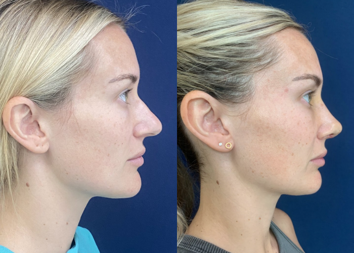 Rhinoplasty Result 01