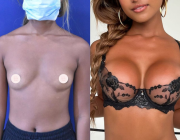 breast augmentation results 01