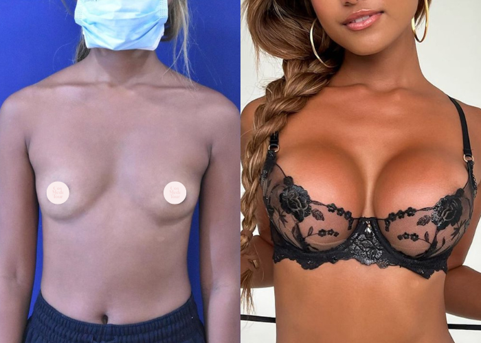 breast augmentation results 01