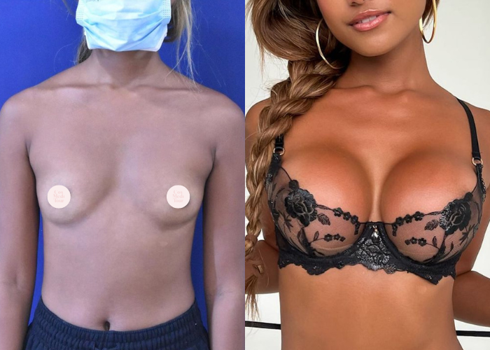 Breast Augmentation Before & After #340