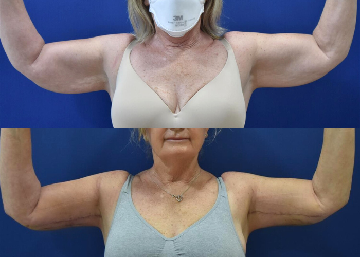 Arm Lift Before & After #19