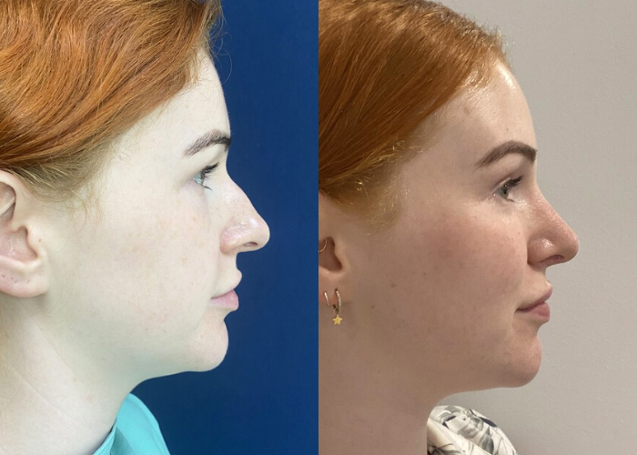 Before & After Rhinoplasty #96