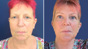 Facelift Result Thailand 01