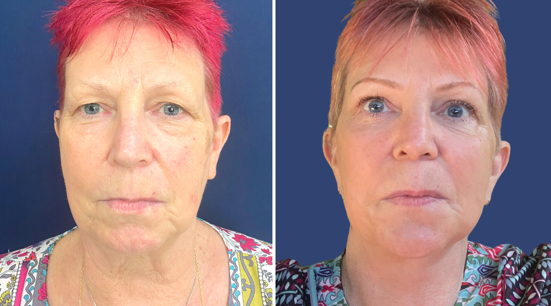 Facelift Before and After #40