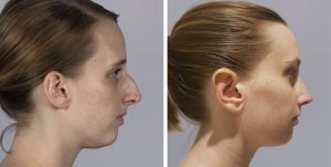 Rhinoplasty nose job before and after photo