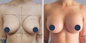 Breast Augmentation boob job before and after photo