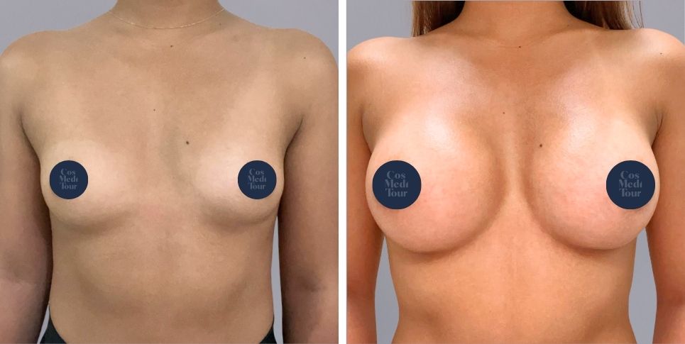 Breast Augmentation boob job before and after photo