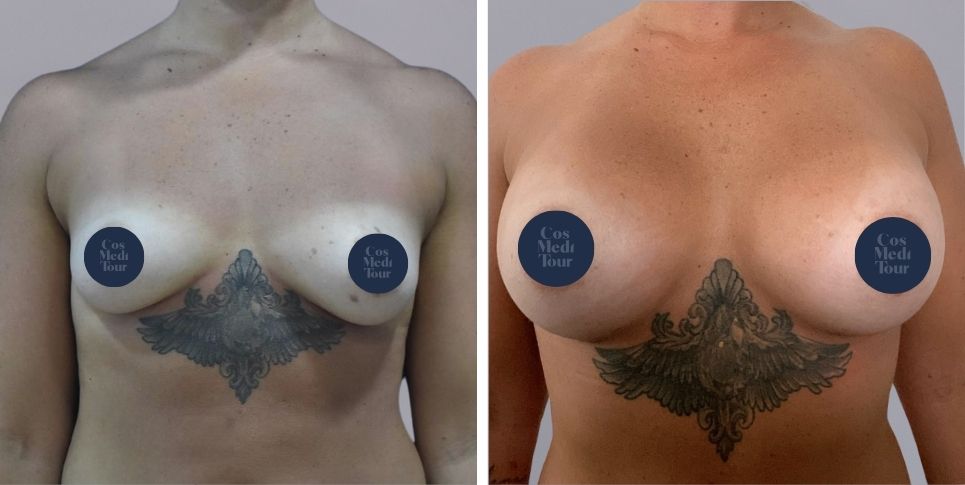 Breast Augmentation boob job before and after photo