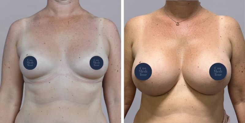 Breast Augmentation boob job before and after photo