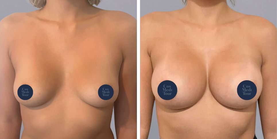 Breast Augmentation boob job before and after photo