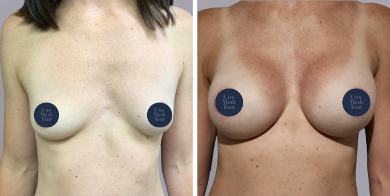 Breast Augmentation boob job before and after photo