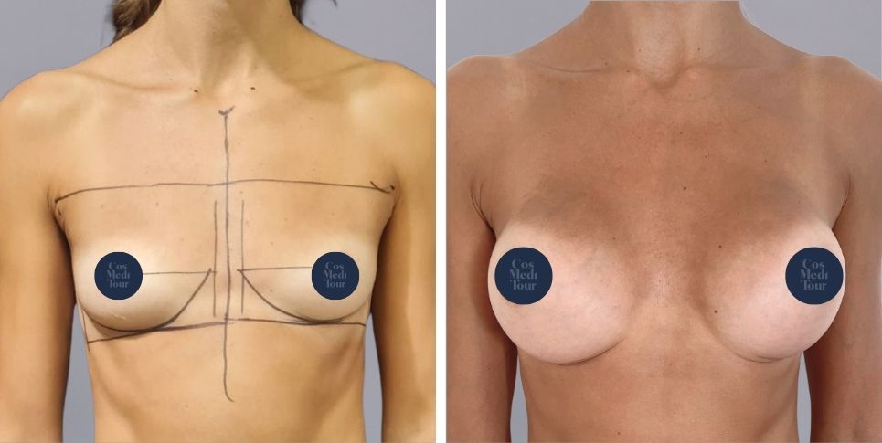 Breast Augmentation boob job before and after photo