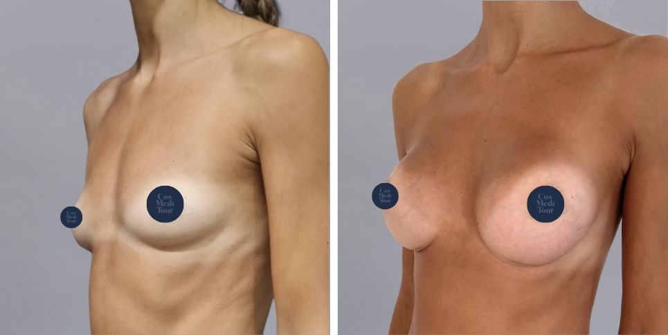 Breast Augmentation boob job before and after photo